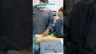 Liposukcja łydek VASER lipo HD [upl. by Blaise215]