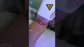 DEPILACIÓN LASER DIODO 4D  MEDICINA ESTÉTICA SER [upl. by Namrehs]