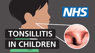 Tonsillitis in children Symptoms and treatment  NHS [upl. by Shulem209]