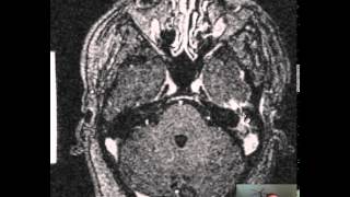 Mastoiditis Brain Abscess DISCUSSION [upl. by Egroj]