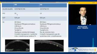 Hypertonie et uvéites  cas clinique Florent Aptel [upl. by Attebasile]