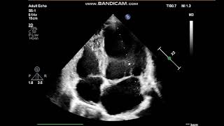 Mitral valve prolapse Severe Mitral regurgitation echocardiography [upl. by Rosella]