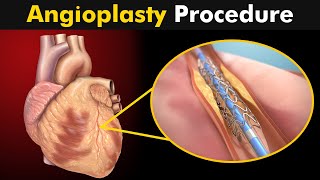 How Angioplasty Procedure is performed [upl. by Leopold]