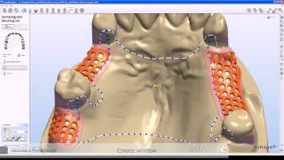 Removable Partial Denture [upl. by Thurman726]