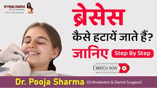 Braces Off  Know Step By Step Dental Braces Removal By In Agra UP  Dr Pooja Sharma [upl. by Baruch509]