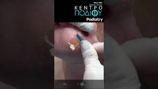 Callus RemovalΚάλος κεντροποδιου kentropodiou podiatry podologia podiatrist foot corn corns [upl. by Durham]