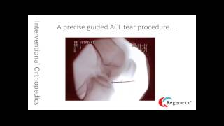 Treating Knee Meniscus Tears and ACL Injuries with Bone Marrow Concentrate [upl. by Revorg581]