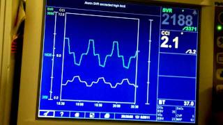 Edwards Vigilance II Patient Cardiac Monitor Data Setup and Demo Mode Vitalsguycom [upl. by Guod]