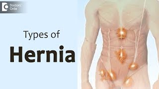 What type of hernia is most severe  Dr Nanda Rajaneesh [upl. by Kcorb]