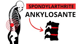 Spondylarthrite Ankylosante  Symptômes Causes Traitement [upl. by Nogam780]