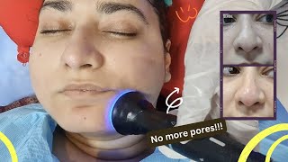 Hydrafacial Treatment Step by Step Explained  Best Facial Ever [upl. by Demetre]