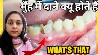 दांत में फोड़ा या मवाद के करण l Tooth ABSCESSdentalcare toothache abscess Thehealthedits [upl. by Ahteres852]