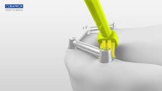 CURAPROX I How to clean Bar Retained implants I English [upl. by Anat]