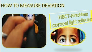 Hirschberg Test Hirschberg Corneal Reflex Test Hirschberg Test Interpretation HBCT Test HBRTCLR [upl. by Nemzaj983]