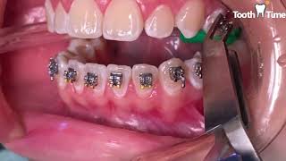 How they put braces on  13 years old patient  Tooth Time Family Dentistry New Braunfels Texas [upl. by Isidoro]