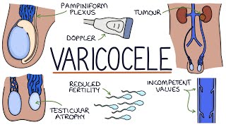 Varicoceles [upl. by Ettezoj]