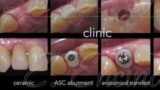 Veneered Scew retained crown with Angulated Screw Channel ASC 1 [upl. by Alejna]