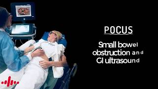 Point of care ultrasound in small bowel obstruction [upl. by Attem]