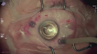 Retinal detachment repair Vista Live Stream [upl. by Emiatej980]