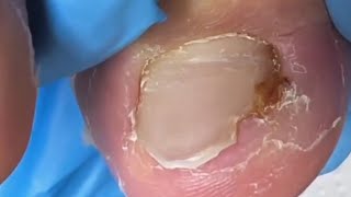 Ingrown toenail removal [upl. by Zuleika]