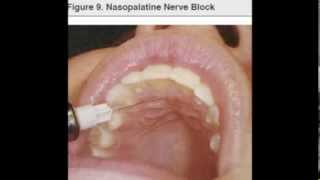 NP nasopalatine nerve block [upl. by Ezeerb]