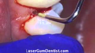 Before and After LANAP Laser Gum Treatment Periodontal charting with dental Probe for gum disease [upl. by Ellehcin]