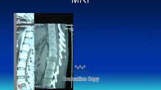 Tumour from Bony elements of the Spinewmv [upl. by Anirbus]