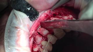 CORTICOTOMY Orthodontic surgery [upl. by Delilah]