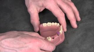 Straumann Implant Level Impressions [upl. by Enyahs]