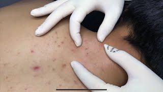 ACNE TREATMENT WITH VU QUYNH MI  Acne on Back amp Chest 2023p1 [upl. by Isbella]