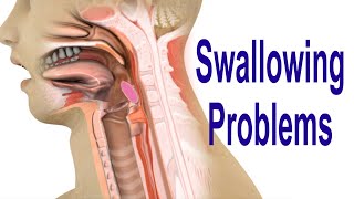 Swallowing Problems or Dysphagia Top 4 Possible Causes Including Cricopharyngeal Dysfunction CPD [upl. by Haron]