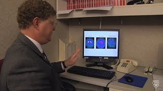 Mayo Clinic Minute What is Lewy body dementia [upl. by Antony]