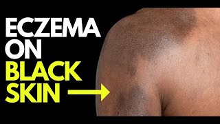 Doctor explains what ECZEMA looks like on BLACK SKIN  plus photos diagnosis and treatment [upl. by Mahau681]