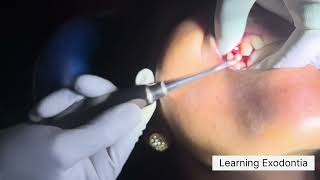 Maxillary first premolar extraction  upper first molar extraction dentist trending youtube [upl. by Alburga]