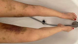 Mes jambes 10 jours après lopération du lipoedème VLOG 12 [upl. by Shimkus752]