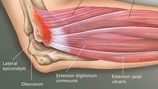 Lateral Epicondylitis tennis elbow exercise [upl. by Woolley]