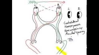 USMLE Review  Neurology Visual Lesions [upl. by Ahsoyem]