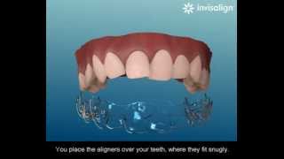 How the Invisalign Brace System Works  Jiva Dental  Kingston [upl. by Anitroc]