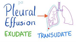 Pleural Effusion  Transudate or Exudate  Causes and Liddle’s Criteria Pulmonary Medicine Playlist [upl. by Adnahs]