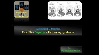 Ultrasound Case 76 Asplenia  Heterotaxy Syndrome [upl. by Euqcaj]