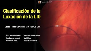 Clasificación de la Luxación de la Lente Intraocular [upl. by Cletus]