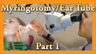 Myringotomy amp Ear Tube Part 1 Feat Dr Tim Fife  Myringotomy  Auburn Medical Group [upl. by Jillian715]