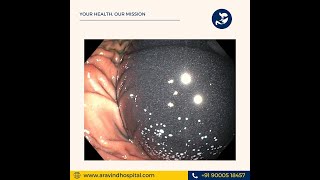 orbera Intra gastric balloon placement [upl. by Astrid]