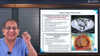 RM 2024 Cirugía 5 Tumores de Apéndice carcinoide mucocele [upl. by Creight]