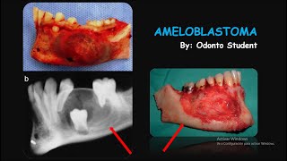 Ameloblastoma Etiología Características  Clínicas Radiográficas Histológicas y Tratamiento [upl. by Forland]