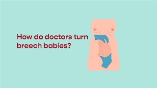 How do Doctors turn Breech babies [upl. by Atinahs]