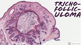 Trichofolliculoma Mother of All Hair Follicles 5Minute Pathology Pearls [upl. by Aerol]