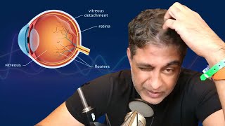 My Surgical Experience with Posterior Vitreous Detachment [upl. by Ahgiela]