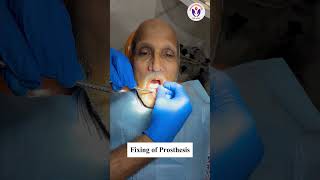 Implant supported fixed Prosthesis for completely edentulous Patient [upl. by Xyno]