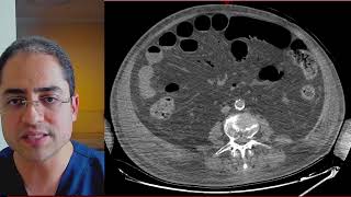 Qual o passo a passo para dar diagnóstico de isquemia mesentérica na TC de Abdome [upl. by Adym191]
